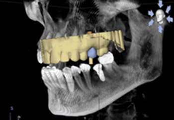ΟΔΟΝΤΙΚΗ ΥΠΟΛΟΓΙΣΤΙΚΗ ΤΟΜΟΓΡΑΦΙΑ (CBCT - DENTAL SCAN)